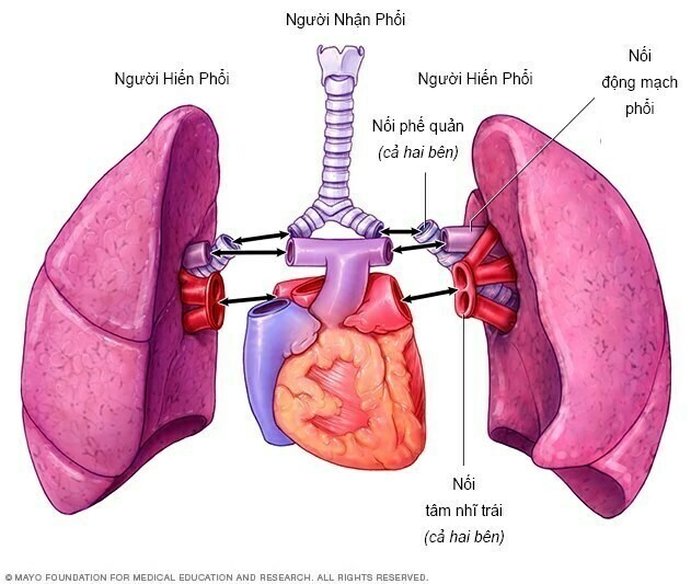 Ghép phổi hai lá.