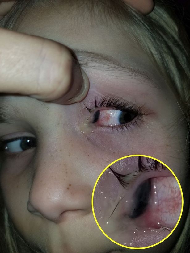 Bọ cánh cứng sống trong mắt bé gái 6 tuổi