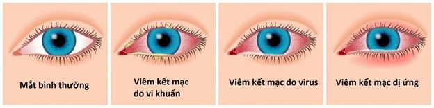 Viêm kết mạc