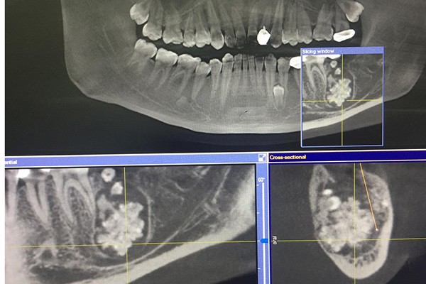 Bác sĩ gắp răng lúc nhúc trong miệng nam thanh niên Hà Nội