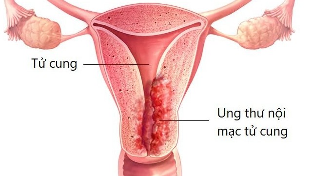 7 dấu hiệu dự báo ung thư nội mạc tử cung