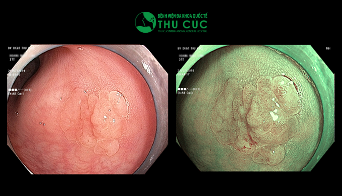 Polyp đại tràng có nguy cơ ung thư hóa qua nội soi NBI phóng đại 100 lần.