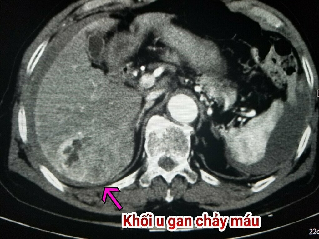 Ảnh CT khối u gan vỡ gây chảy máu của bệnh nhân. Ảnh: Bệnh viện cung cấp.