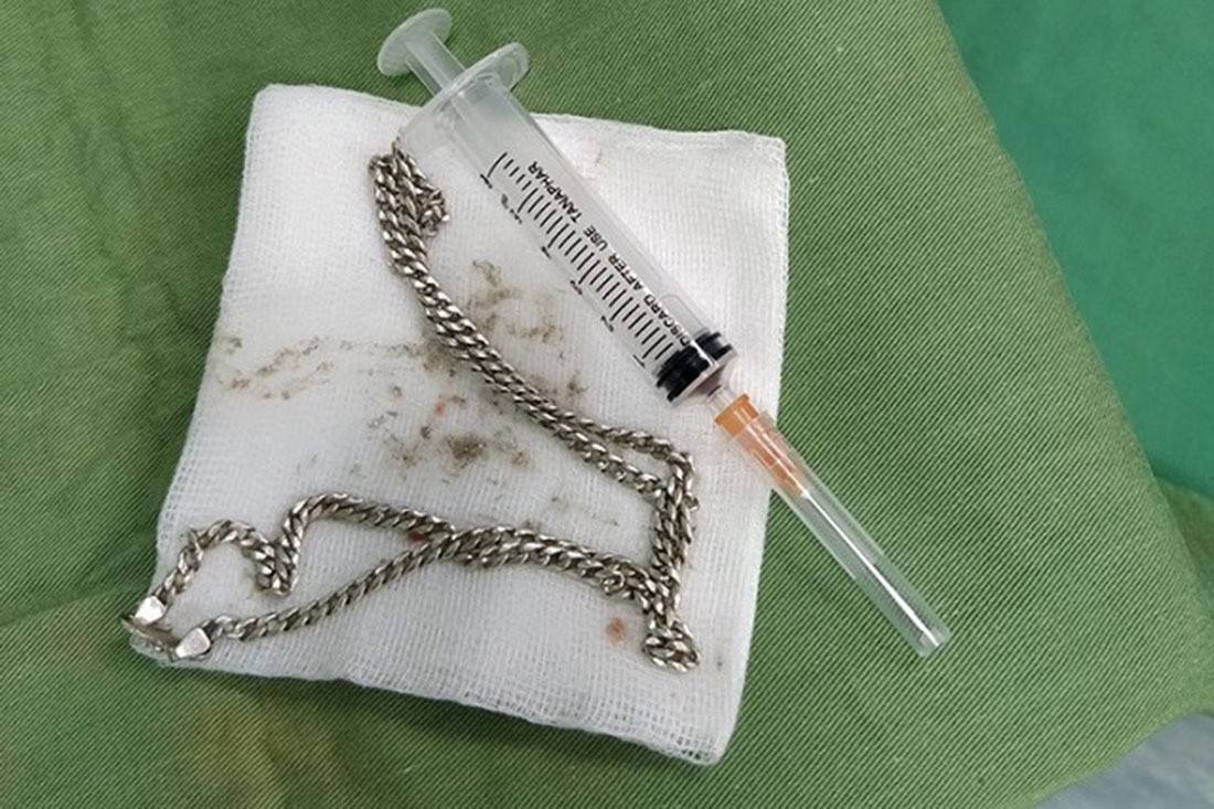 Gắp sợi dây chuyền bạc từ bụng bệnh nhi 29 tháng tuổi