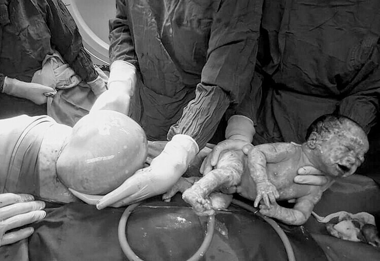 Một bé trong đôi song sinh chào đời nguyên bọc ối