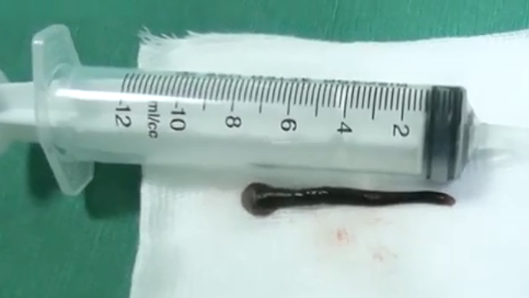 Con đỉa dài bằng ngón tay bám trong phổi