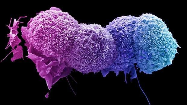 Hình ảnh các tế bào ung thư ở phổi. Ảnh: Science Cancer Research