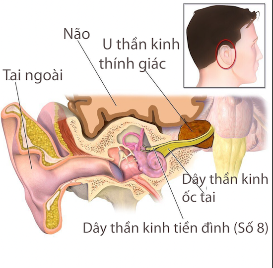 Hình minh hoạ khối u thần kinh thính giác trong tai