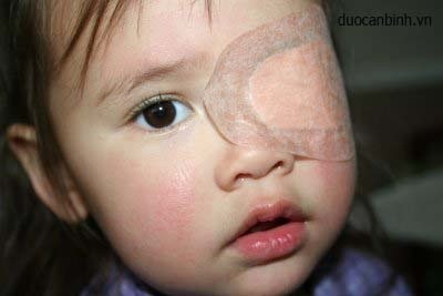 3 triệu trẻ Việt Nam cần điều trị nhược thị sớm