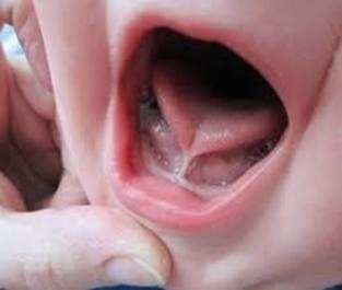 Dính lưỡi – nguyên nhân gây ảnh hưởng đến sự phát âm của trẻ