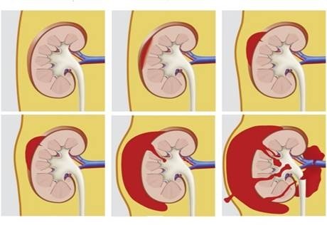 Hình ảnh: Phân loại chấn thương thận theo Hiệp hội chấn thương Hoa Kỳ