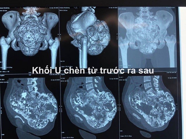 Hình ảnh khối u trên phim trước mổ.