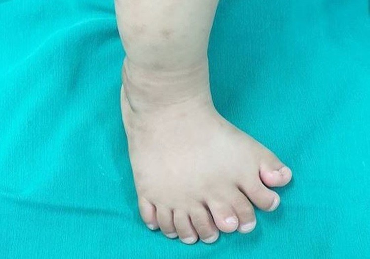 Bé trai có 9 ngón trên một bàn chân