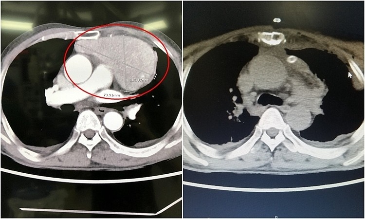 Hình ảnh CT khối u trung thất kích thước lớn nằm đè lên tim trước và sau khi phẫu thuật. Ảnh: Bệnh viện cung cấp