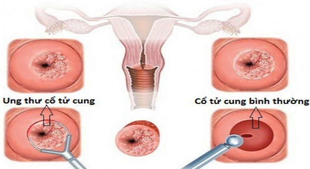 Ung thư cổ tử cung có thể điều trị khỏi, bảo tồn cơ quan sinh sản nếu được phát hiện ở giai đoạn sớm. Ảnh: Y học cộng đồng