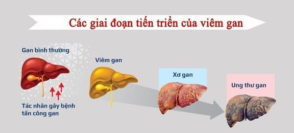 Viêm gan âm thầm diễn tiến thành nhiều bệnh lý nguy hiểm.