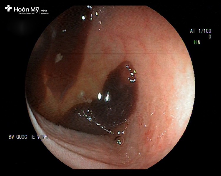 Hình ảnh sán lá ruột lớn (kích thước 2 - 3cm) bám chặt lên thành ruột bệnh nhân. Ảnh: Bệnh viện cung cấp