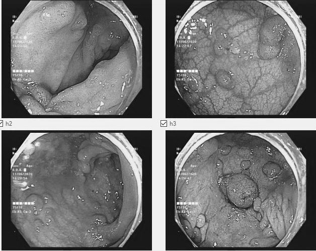 Hình ảnh nội soi polyp đại tràng của nữ bệnh nhân. Ảnh: Bệnh viện cung cấp.