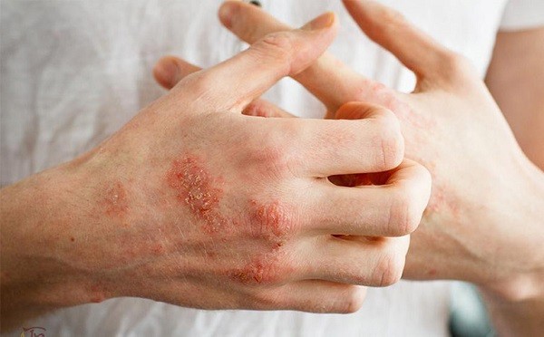 Bệnh eczema chữa khỏi được không?