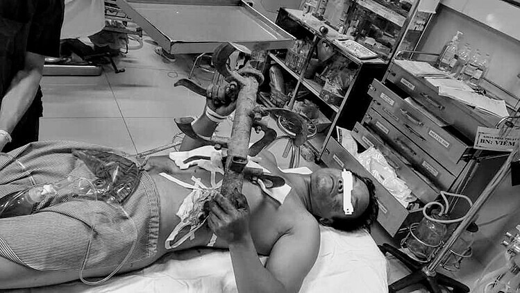 Lưỡi máy phay cắm vào cơ thể bệnh nhân. Ảnh: Bệnh viện cung cấp