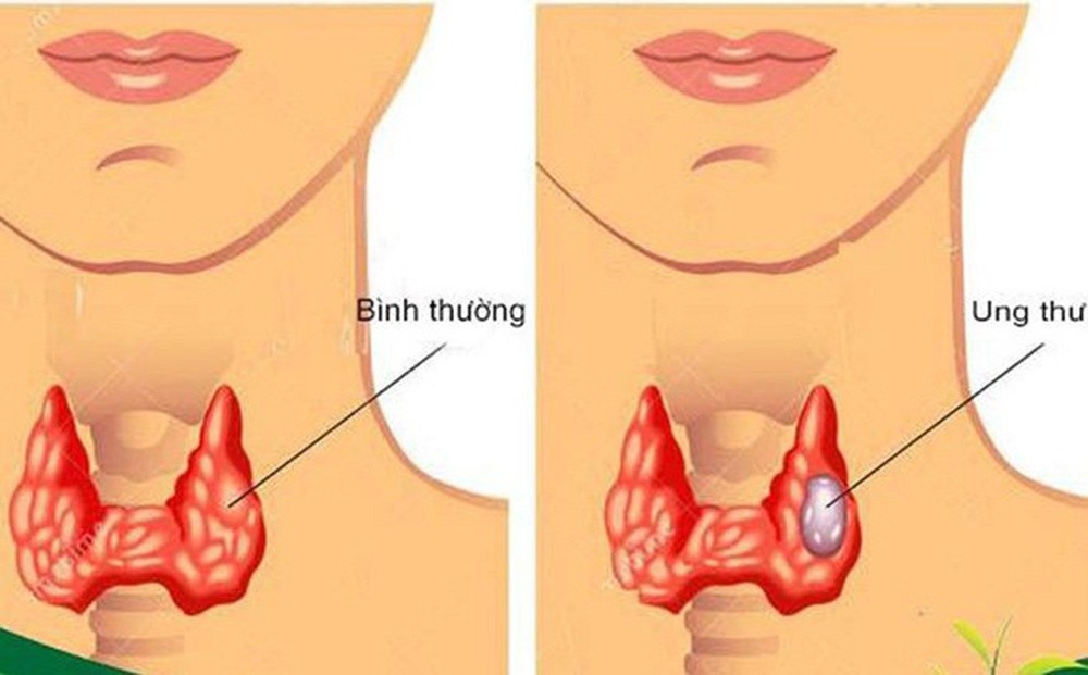 Phẫu thuật đóng vai trò quan trọng nhất, có tính chất quyết định đến kết quả điều trị ung thư tuyến giáp (Ảnh minh họa)