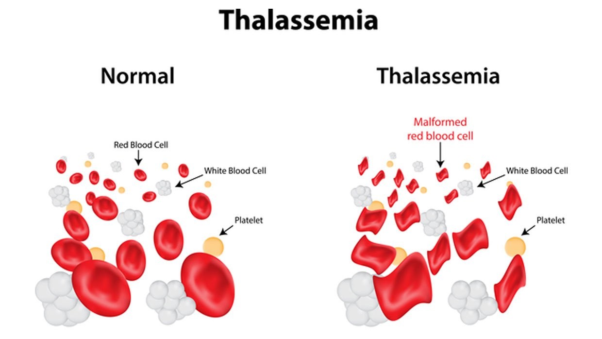 Mang gene bệnh Thalassemia có nên sinh con?