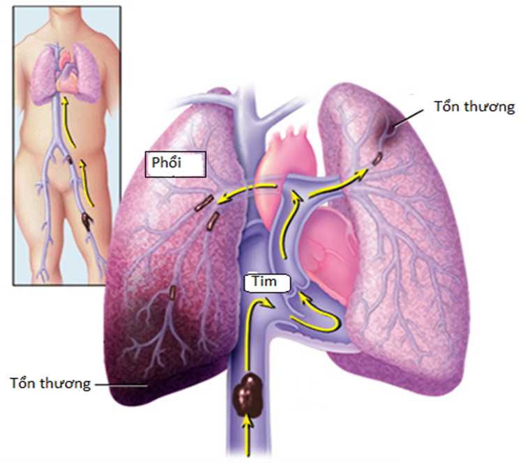 Mô phỏng diễn biến tắc động mạch phổi. Ảnh: Mayo Clinic.