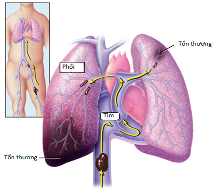 Cục máu đông từ chân chạy vào phổi gây đột quỵ
