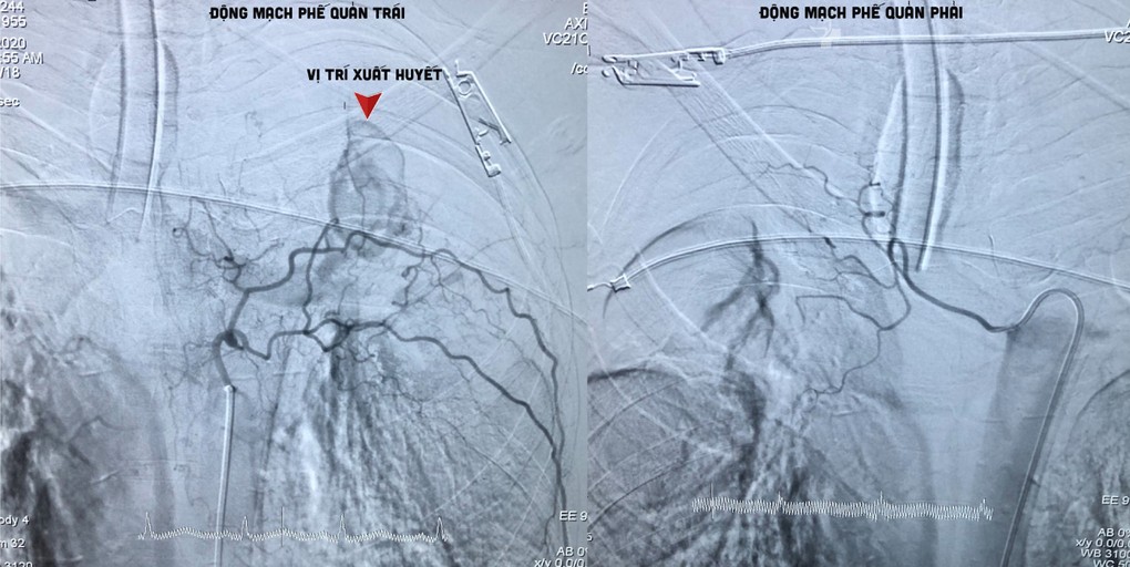 Hình ảnh động mạch phế quản bệnh nhân bị vỡ, gây xuất huyết, nôn ra máu. Ảnh Bệnh viện cung cấp