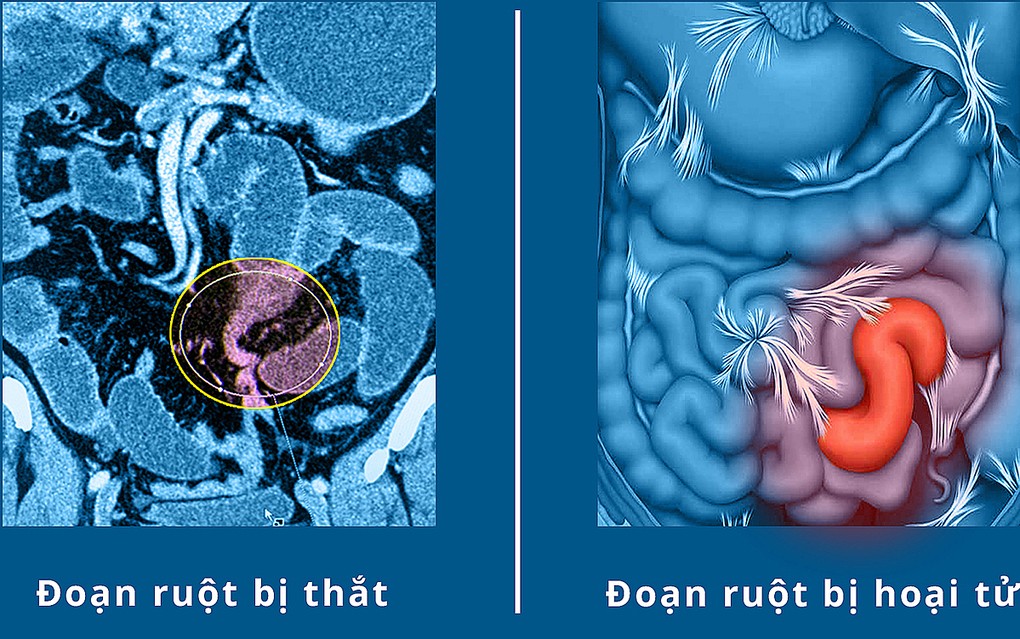 Ảnh chụp cắt lớp vi tính ruột của bệnh nhân. Ảnh do bệnh viện cung cấp.