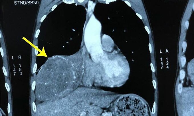 Xẹp phổi bởi khối u trong lồng ngực