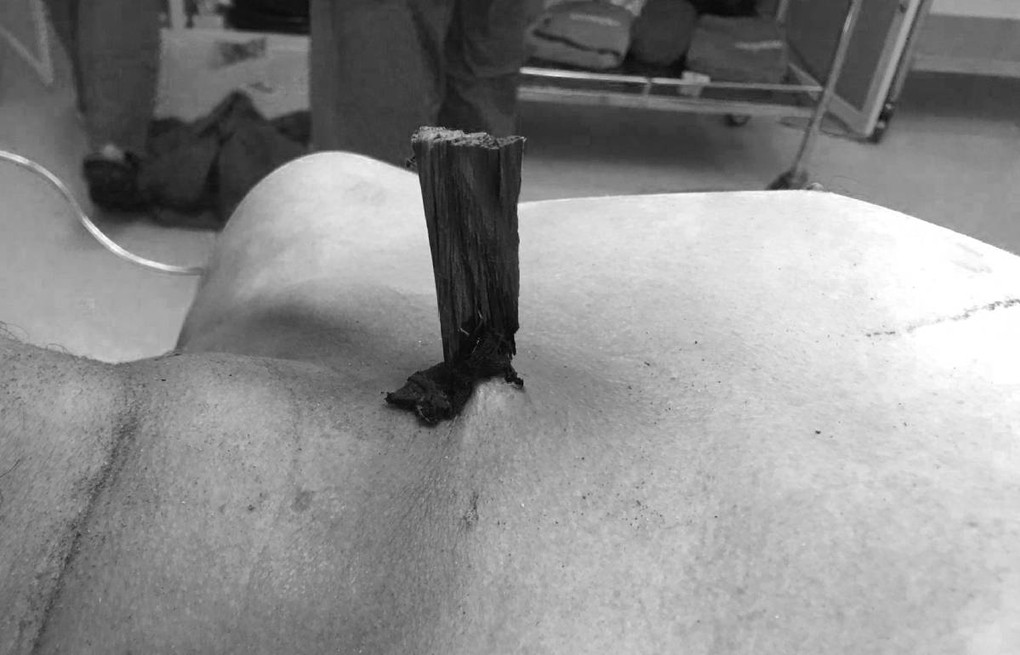 Cứu công nhân bị thanh gỗ đâm xuyên ức