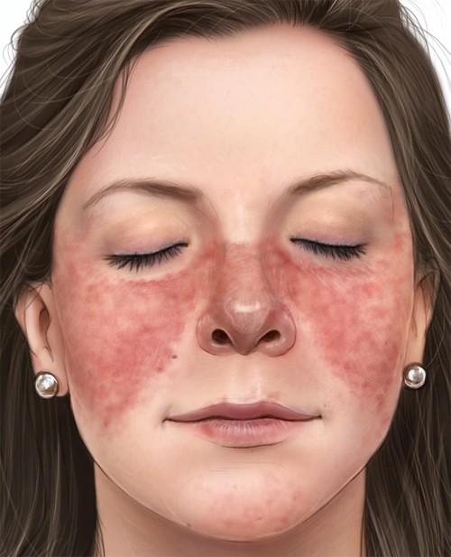 Trên mặt nổi ban đỏ cánh bướm, tóc giòn rụng nhiều là dấu hiệu của lupus. Ảnh: Mayo Clinic