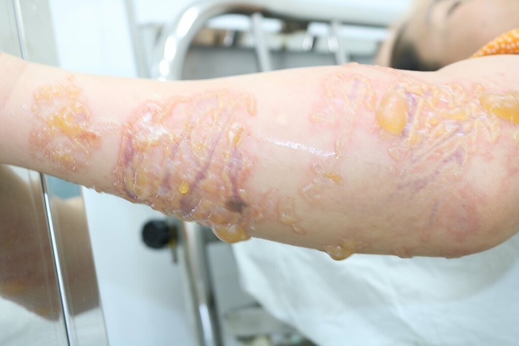 Người phụ nữ đến Bệnh viện Da liễu TP HCM với cánh tay phồng rộp, rỉ dịch sau khi tiếp xúc nọc độc của sứa biển. Ảnh: Lan Anh.