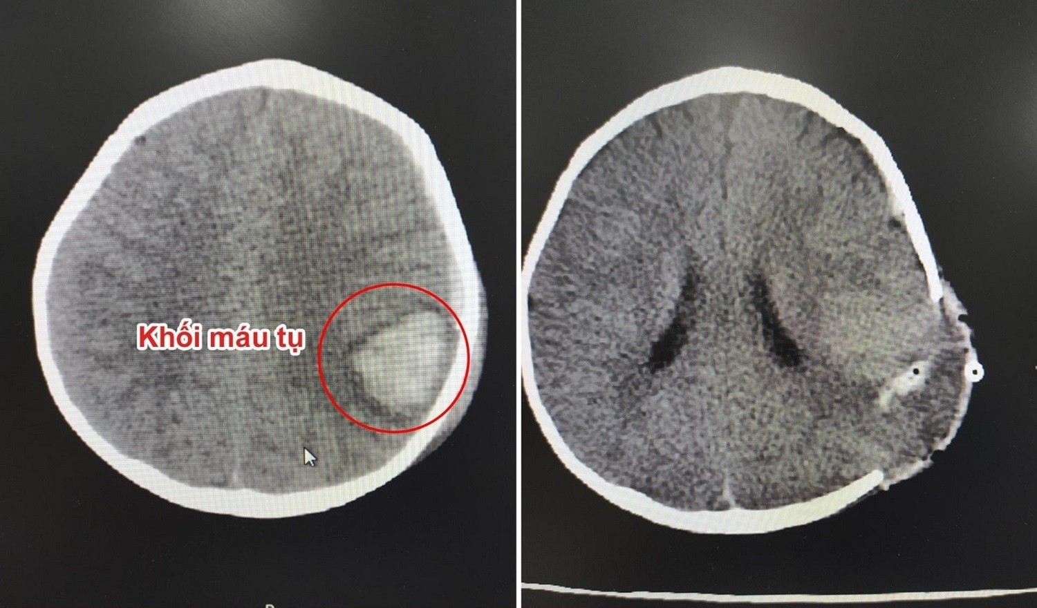 Hình ảnh trước và sau phẫu thuật lấy máu tụ nội sọ cho bé
