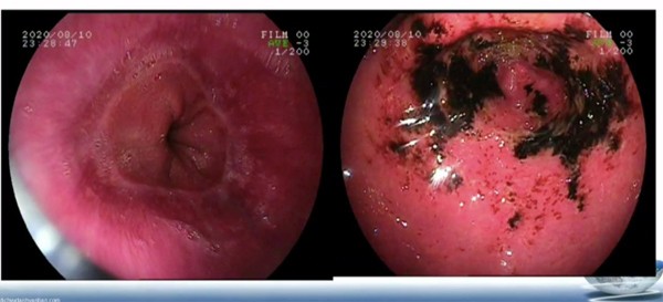 Hình ảnh nội soi dạ dày bệnh nhân phát hiện bị loét, chảy máu