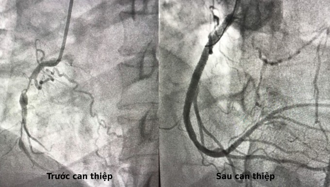 Hình ảnh trước và sau khi can thiệp cho thấy dòng máu vào tim bệnh nhân đã thông suốt. Ảnh: Bác sĩ cung cấp.