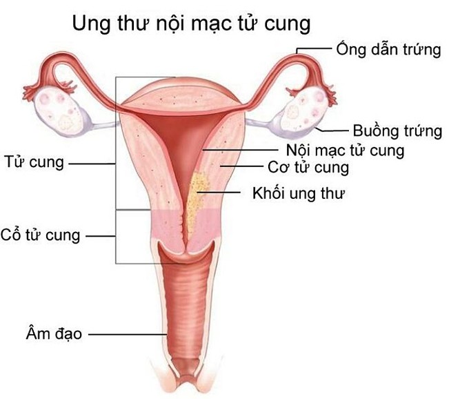 Quá sản nội mạc tử cung tiến triển thành ung thư vì không điều trị sớm.