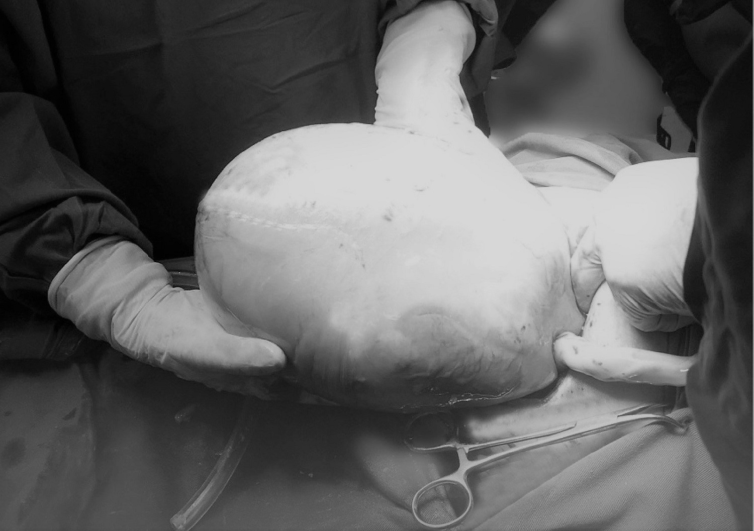 Một bé trong ca song sinh chào đời còn nguyên trong bọc ối