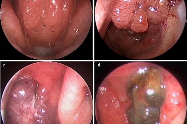 Hình ảnh ung thư vòm họng