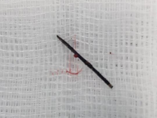 Sốt kéo dài bởi cây kim khâu trong cơ thể