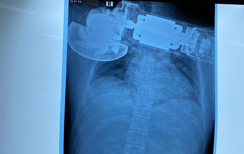 Cứu bệnh nhân bị máy chà găm vào ngực