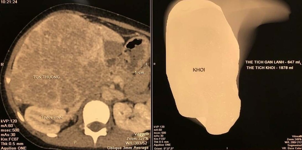 Khối u chiếm toàn bộ phần gan phải trên phim chụp CT bụng. Ảnh: Bác sĩ cung cấp.