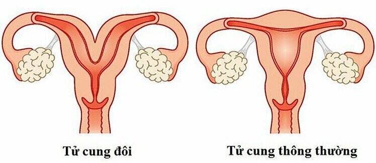 Hình ảnh minh họa tử cung thông thường và tử cung đôi.