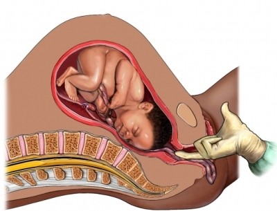 Mô phỏng tình trạng sa dây rốn - nguy cơ tử vong cao cho thai nhi nếu dây rốn không được giảm áp lực kịp thời hoặc không nhanh chóng mổ sản phụ hoặc kẹp em bé ra. Đồ họa: NMM
