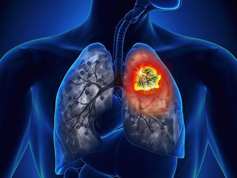 Ung thư phổi khó chữa khỏi nếu đến viện muộn