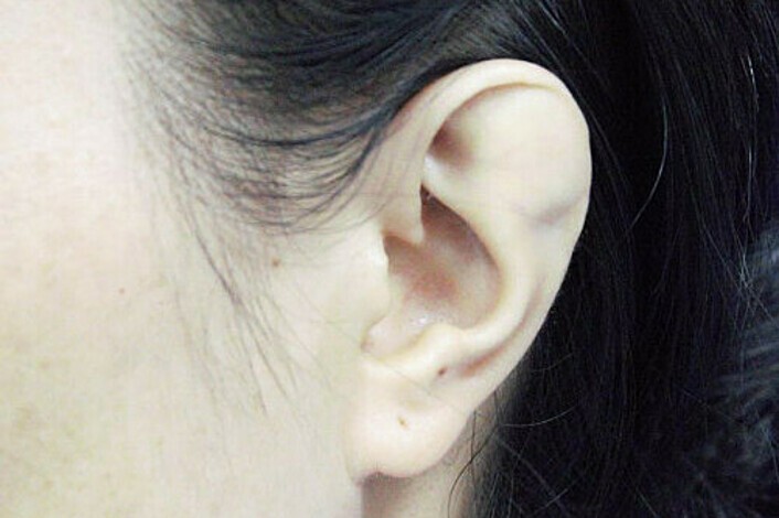 Vành tai bất thường của người phụ nữ trước mổ. Ảnh: Bệnh viện cung cấp.
