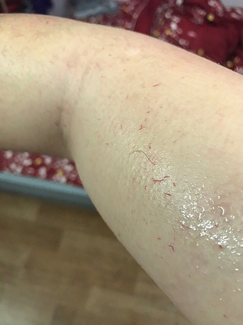 Mồ hôi bệnh nhân có màu đỏ. Ảnh: Bác sĩ cung cấp