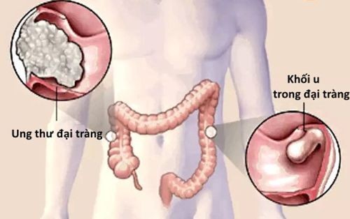 Mô phỏng khối u đại tràng. Ảnh: News.