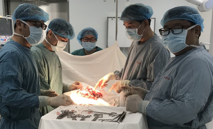 Các bác sĩ bóc tách trọn khối u khoảng 3,5 kg sau 5 giờ phẫu thuật. Ảnh: An Nguyễn.